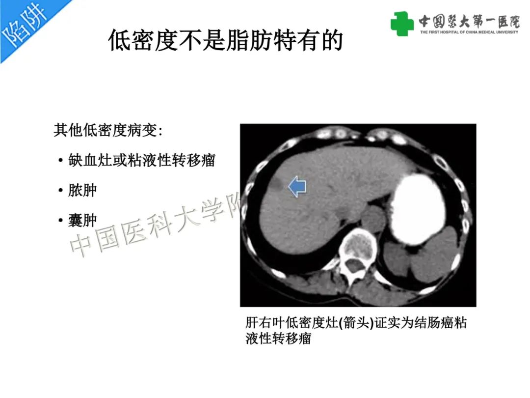 影像PPT - 【PPT】是脂是敌？肝脏良性含脂病变与相似的恶性病变鉴别诊断-17