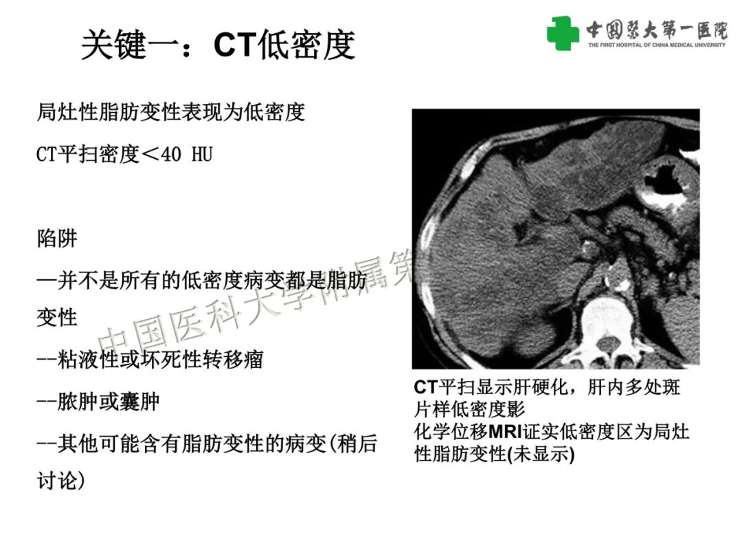 影像PPT - 【PPT】是脂是敌？肝脏良性含脂病变与相似的恶性病变鉴别诊断-16