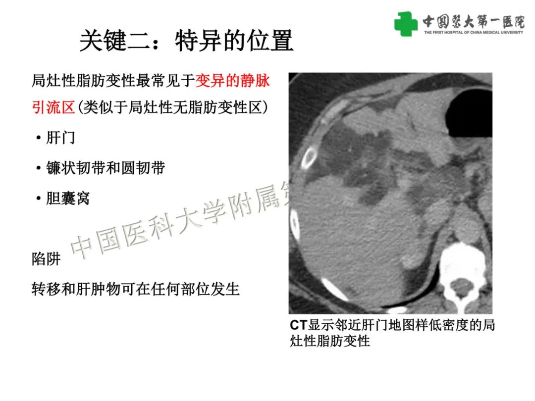 影像PPT - 【PPT】是脂是敌？肝脏良性含脂病变与相似的恶性病变鉴别诊断-18