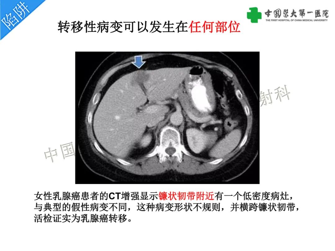 影像PPT - 【PPT】是脂是敌？肝脏良性含脂病变与相似的恶性病变鉴别诊断-19