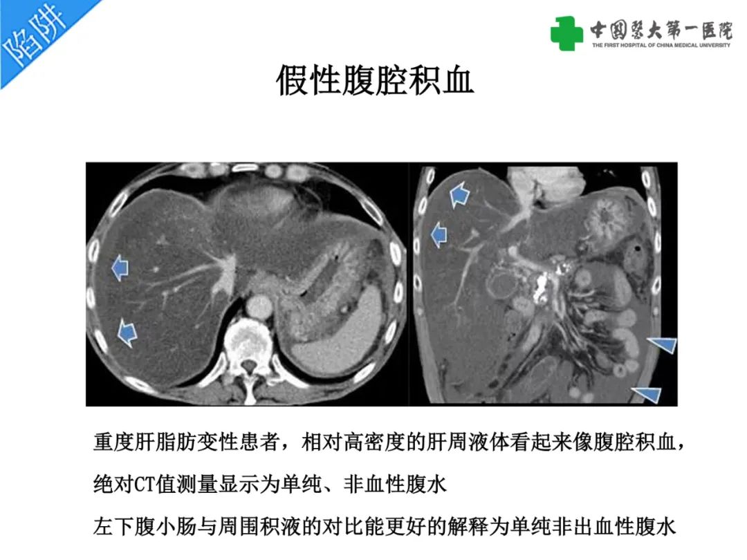 影像PPT - 【PPT】是脂是敌？肝脏良性含脂病变与相似的恶性病变鉴别诊断-8