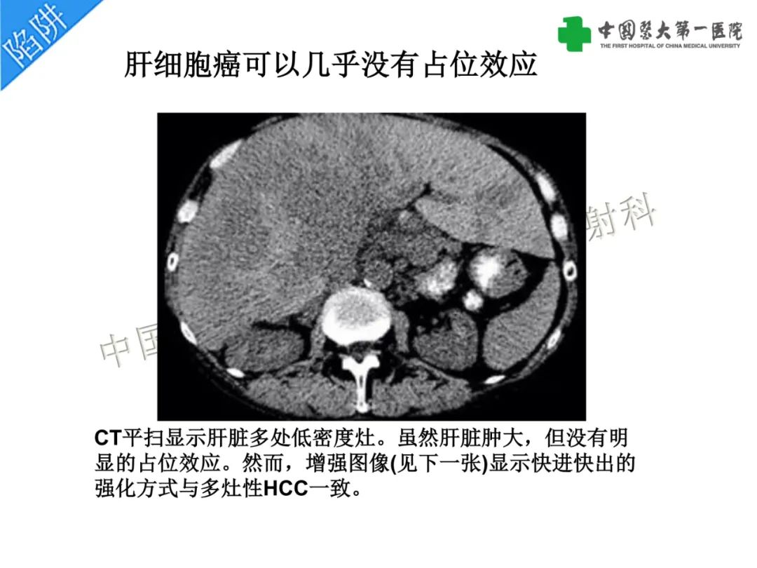 影像PPT - 【PPT】是脂是敌？肝脏良性含脂病变与相似的恶性病变鉴别诊断-21