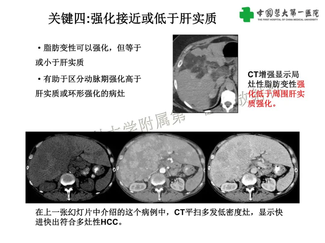 影像PPT - 【PPT】是脂是敌？肝脏良性含脂病变与相似的恶性病变鉴别诊断-22