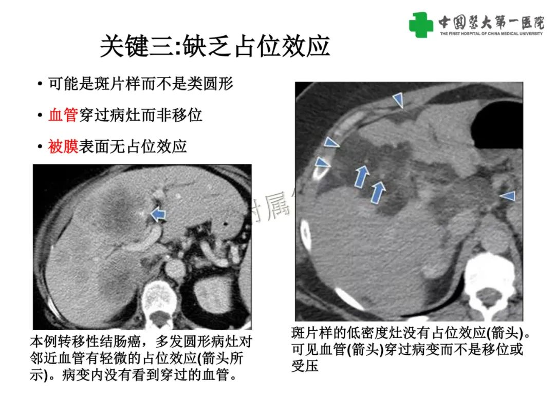 影像PPT - 【PPT】是脂是敌？肝脏良性含脂病变与相似的恶性病变鉴别诊断-20