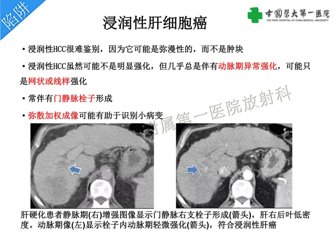影像PPT - 【PPT】是脂是敌？肝脏良性含脂病变与相似的恶性病变鉴别诊断-23