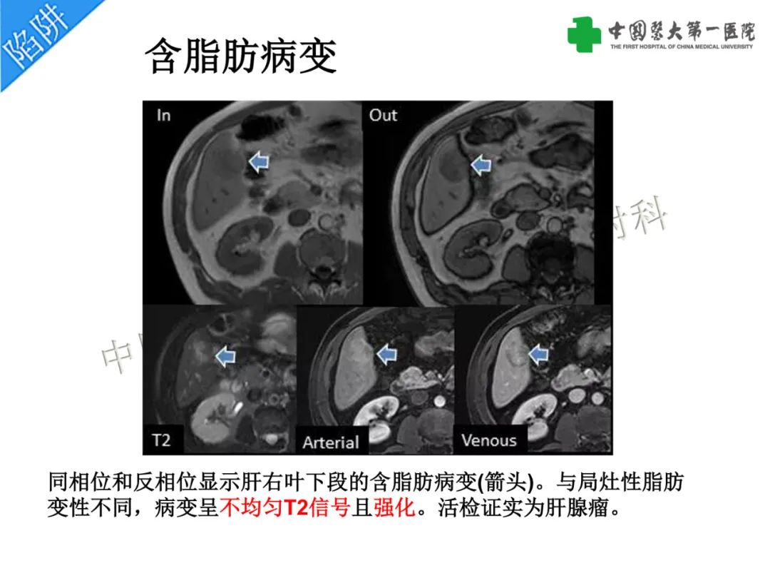 影像PPT - 【PPT】是脂是敌？肝脏良性含脂病变与相似的恶性病变鉴别诊断-25