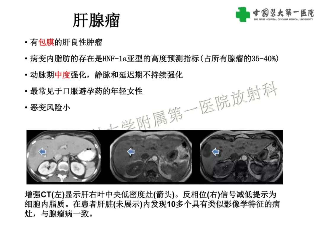 影像PPT - 【PPT】是脂是敌？肝脏良性含脂病变与相似的恶性病变鉴别诊断-27