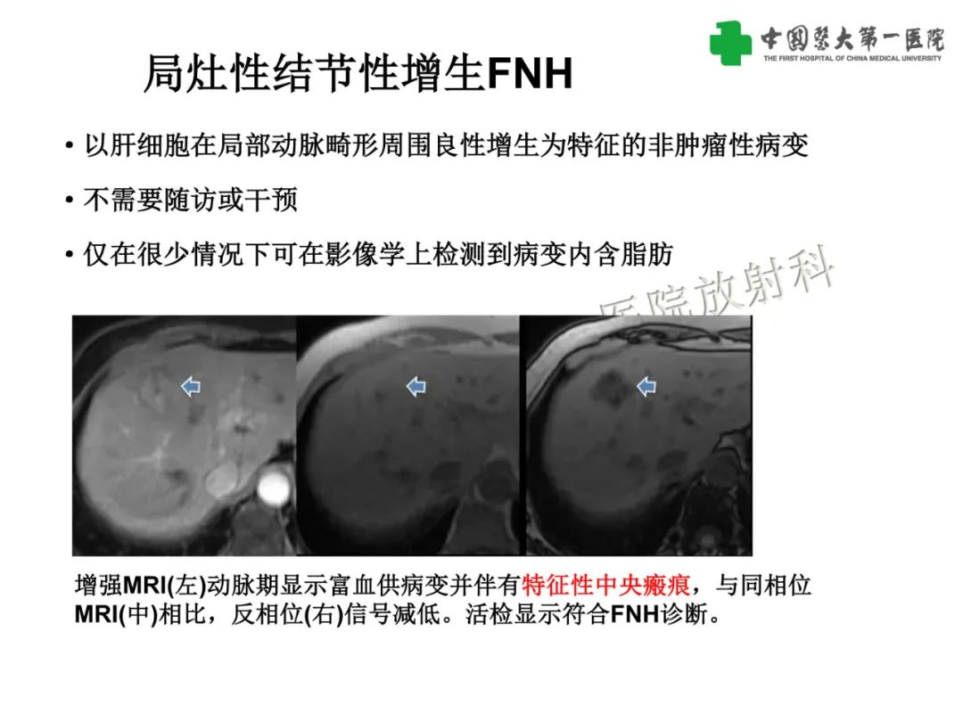 影像PPT - 【PPT】是脂是敌？肝脏良性含脂病变与相似的恶性病变鉴别诊断-28