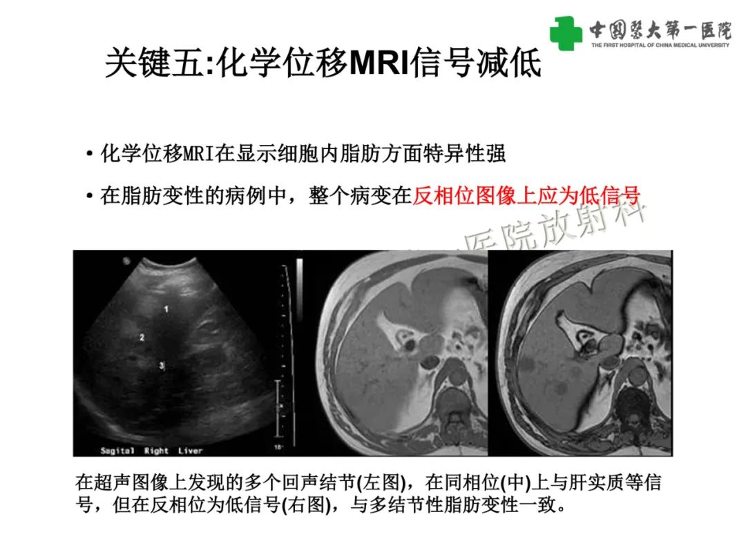 影像PPT - 【PPT】是脂是敌？肝脏良性含脂病变与相似的恶性病变鉴别诊断-24