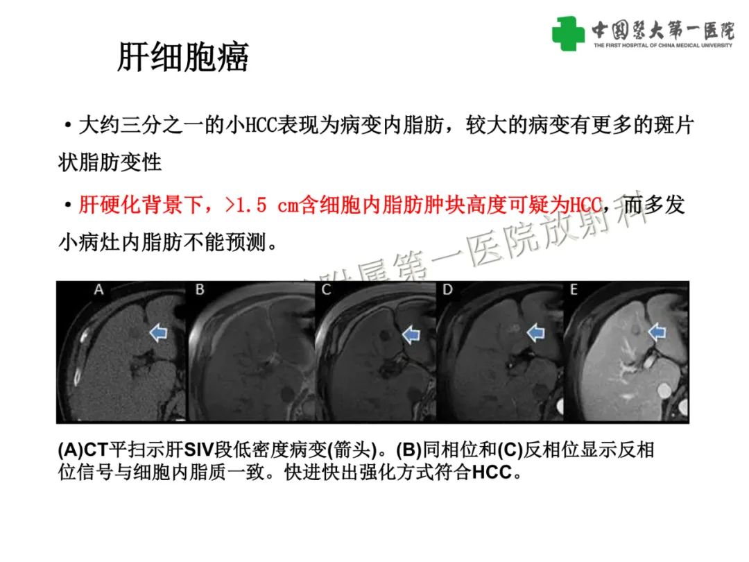 影像PPT - 【PPT】是脂是敌？肝脏良性含脂病变与相似的恶性病变鉴别诊断-29