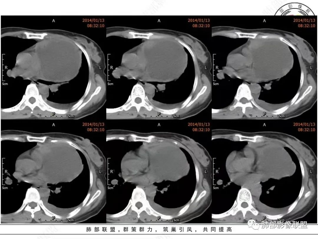 影像PPT - 【病例】前纵隔囊性占位1例诊断与鉴别诊断思路-6 影像PPT - 【病例】前纵隔囊性占位1例诊断与鉴别诊断思路-6