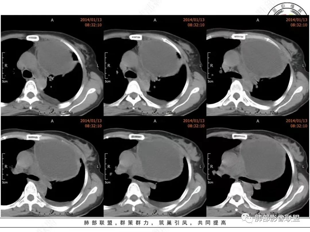 影像PPT - 【病例】前纵隔囊性占位1例诊断与鉴别诊断思路-5 影像PPT - 【病例】前纵隔囊性占位1例诊断与鉴别诊断思路-5