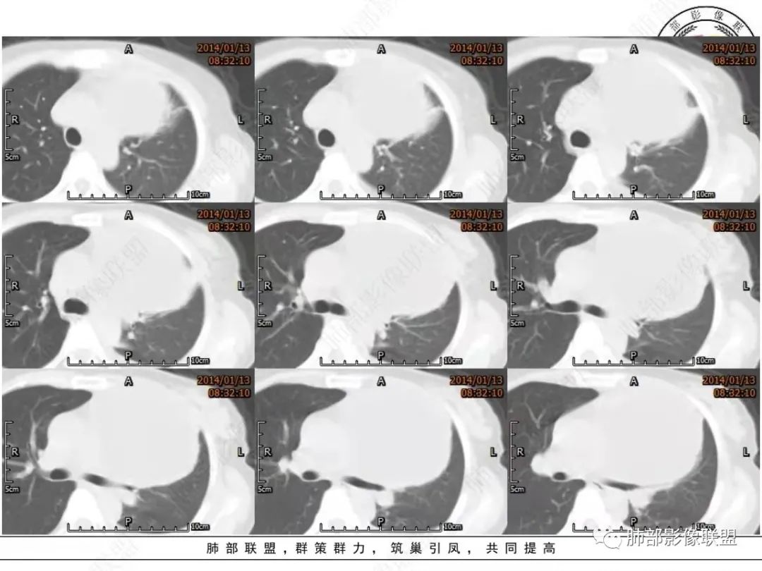 影像PPT - 【病例】前纵隔囊性占位1例诊断与鉴别诊断思路-9 影像PPT - 【病例】前纵隔囊性占位1例诊断与鉴别诊断思路-9
