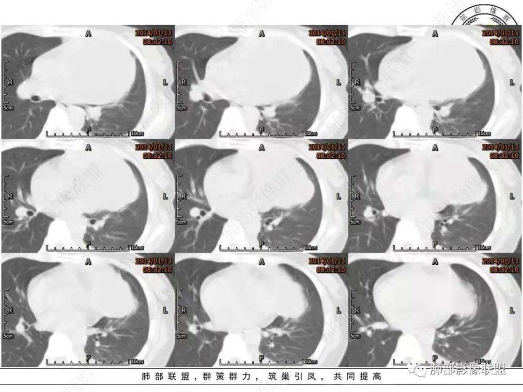 影像PPT - 【病例】前纵隔囊性占位1例诊断与鉴别诊断思路-8 影像PPT - 【病例】前纵隔囊性占位1例诊断与鉴别诊断思路-8