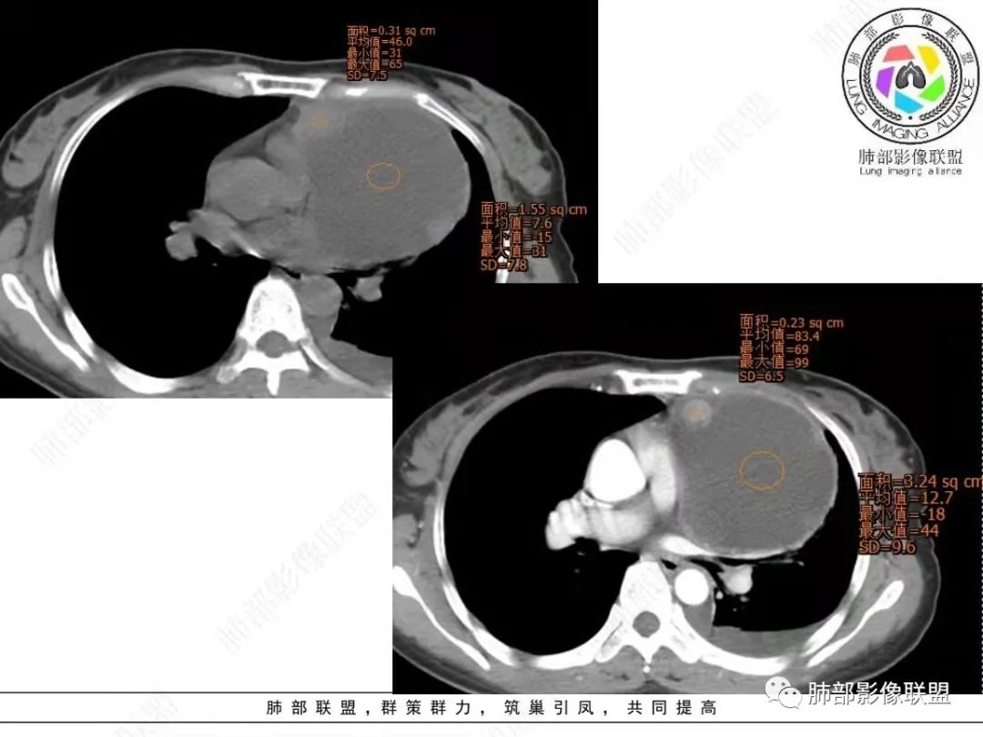 影像PPT - 【病例】前纵隔囊性占位1例诊断与鉴别诊断思路-14 影像PPT - 【病例】前纵隔囊性占位1例诊断与鉴别诊断思路-14