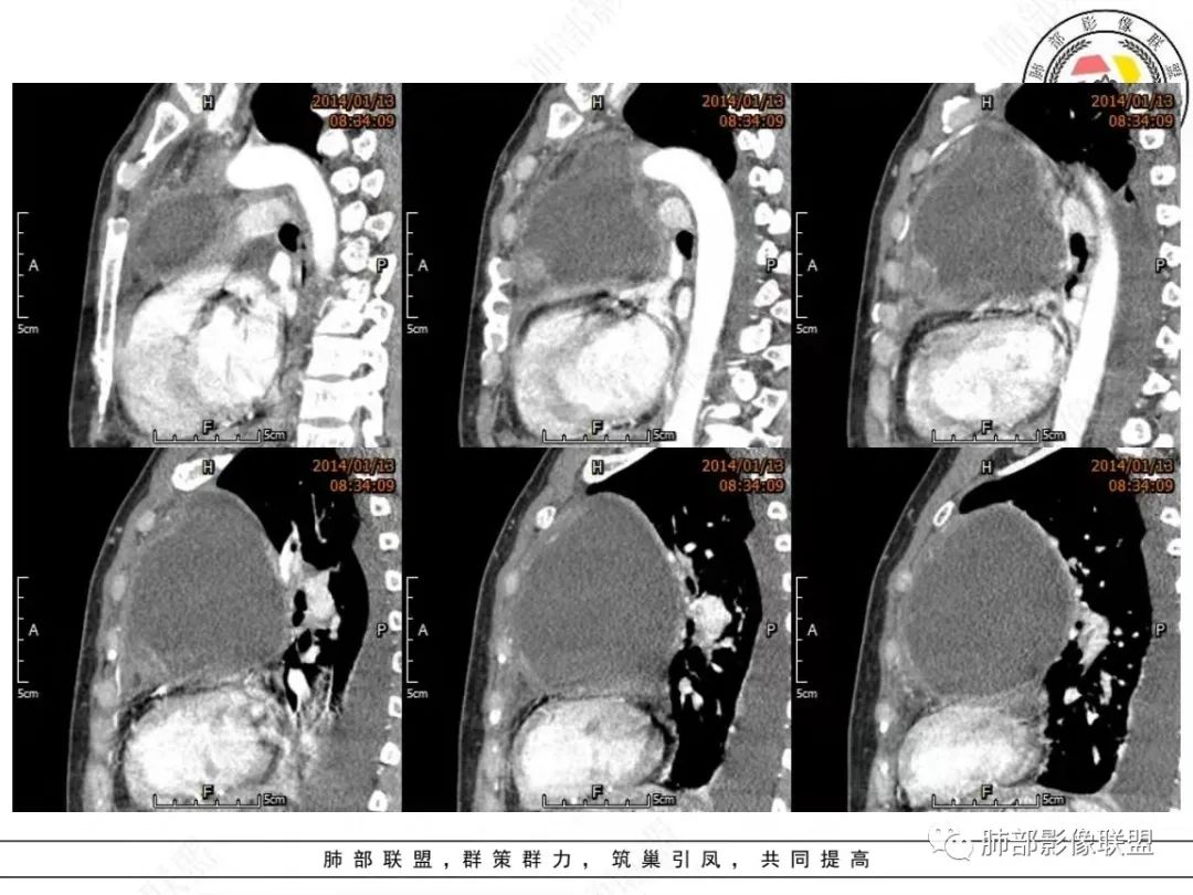 影像PPT - 【病例】前纵隔囊性占位1例诊断与鉴别诊断思路-15 影像PPT - 【病例】前纵隔囊性占位1例诊断与鉴别诊断思路-15