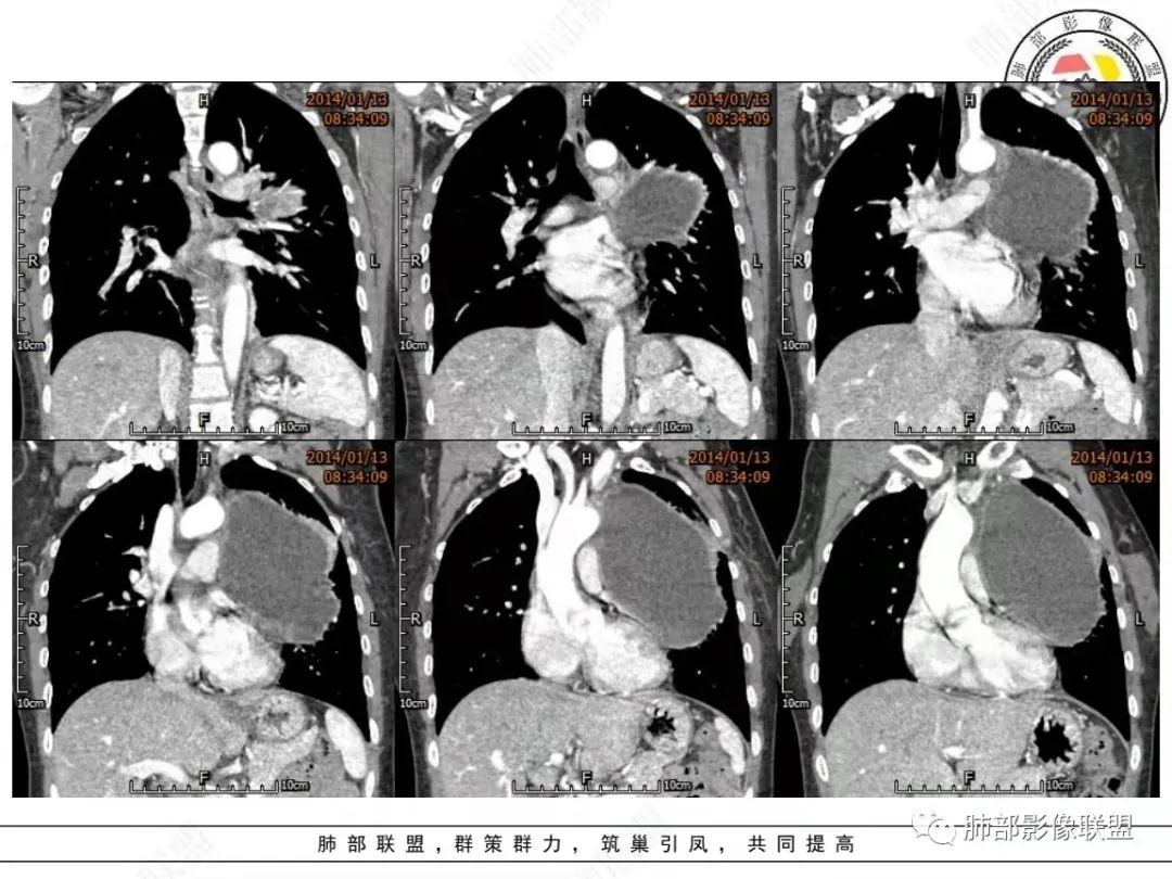 影像PPT - 【病例】前纵隔囊性占位1例诊断与鉴别诊断思路-17 影像PPT - 【病例】前纵隔囊性占位1例诊断与鉴别诊断思路-17