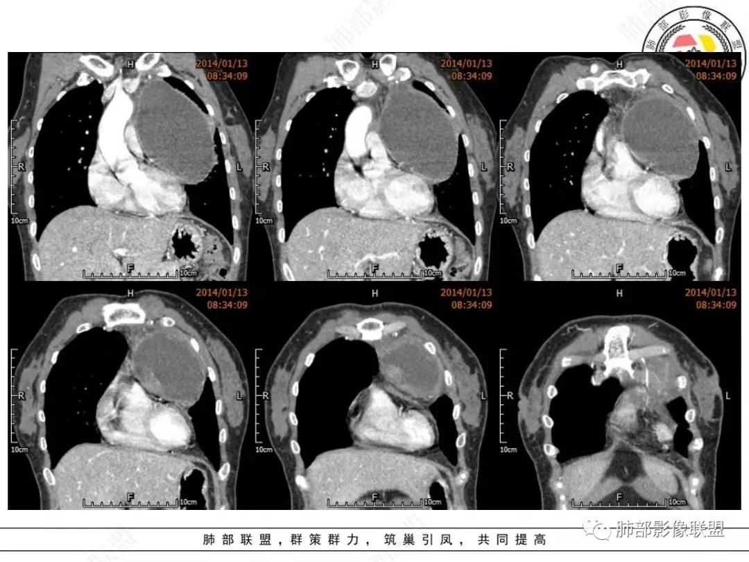 影像PPT - 【病例】前纵隔囊性占位1例诊断与鉴别诊断思路-18 影像PPT - 【病例】前纵隔囊性占位1例诊断与鉴别诊断思路-18