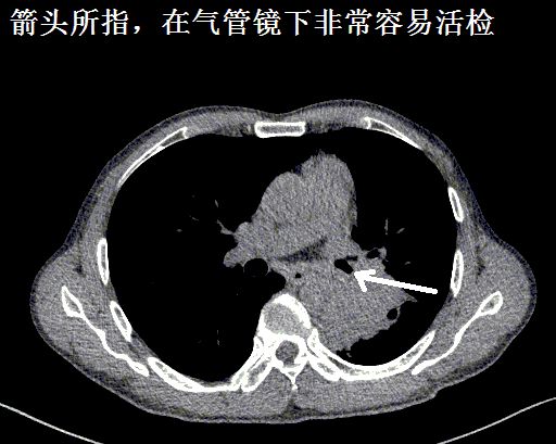 影像PPT - 气管镜活检致命大咯血:这些CT上不起眼的病灶,都是血管畸形-1 影像PPT - 气管镜活检致命大咯血:这些CT上不起眼的病灶,都是血管畸形-1