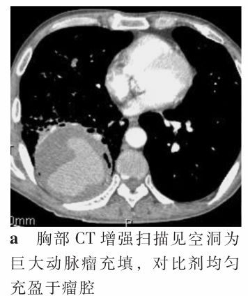 影像PPT - 气管镜活检致命大咯血:这些CT上不起眼的病灶,都是血管畸形-8 影像PPT - 气管镜活检致命大咯血:这些CT上不起眼的病灶,都是血管畸形-8