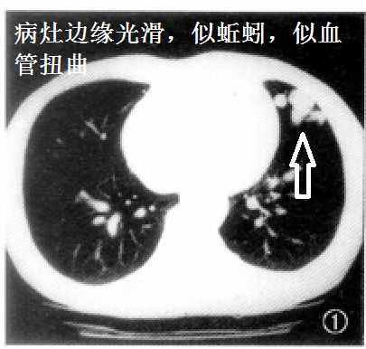 影像PPT - 气管镜活检致命大咯血:这些CT上不起眼的病灶,都是血管畸形-11 影像PPT - 气管镜活检致命大咯血:这些CT上不起眼的病灶,都是血管畸形-11