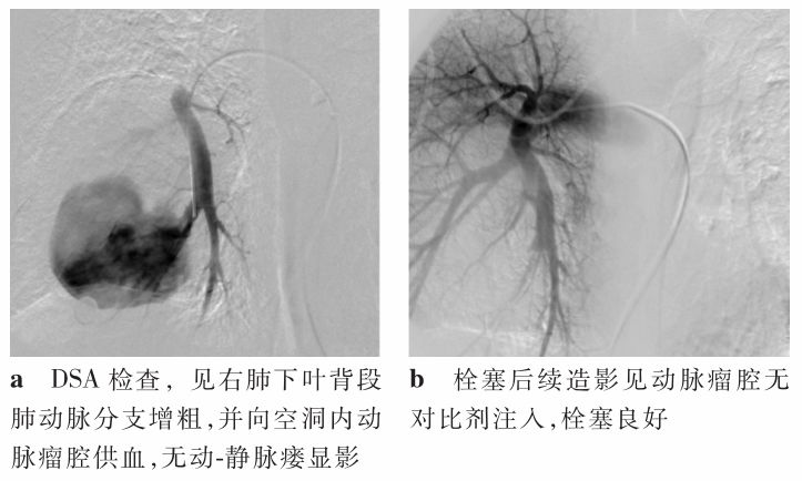影像PPT - 气管镜活检致命大咯血:这些CT上不起眼的病灶,都是血管畸形-10 影像PPT - 气管镜活检致命大咯血:这些CT上不起眼的病灶,都是血管畸形-10