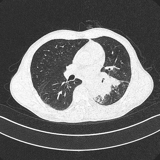 影像PPT - 气管镜活检致命大咯血:这些CT上不起眼的病灶,都是血管畸形-22 影像PPT - 气管镜活检致命大咯血:这些CT上不起眼的病灶,都是血管畸形-22