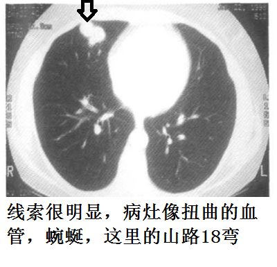 影像PPT - 气管镜活检致命大咯血:这些CT上不起眼的病灶,都是血管畸形-18 影像PPT - 气管镜活检致命大咯血:这些CT上不起眼的病灶,都是血管畸形-18