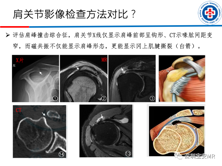 影像PPT - 【PPT】肩关节磁共振检查-4