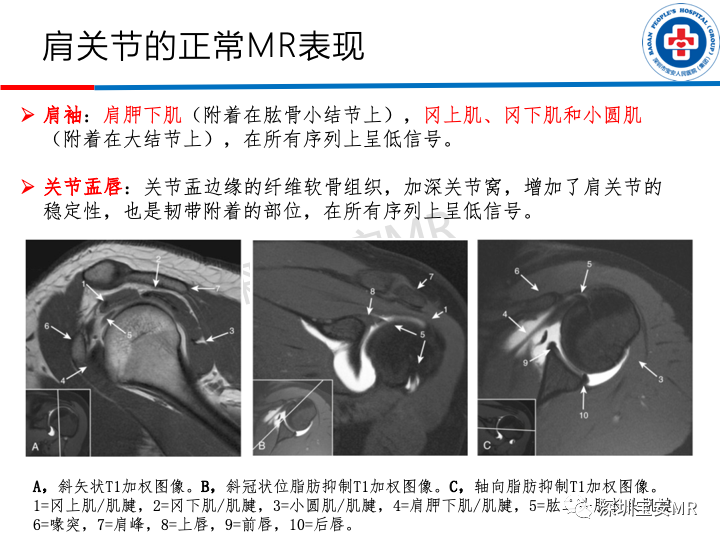 影像PPT - 【PPT】肩关节磁共振检查-6