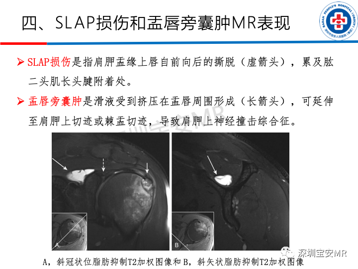 影像PPT - 【PPT】肩关节磁共振检查-11