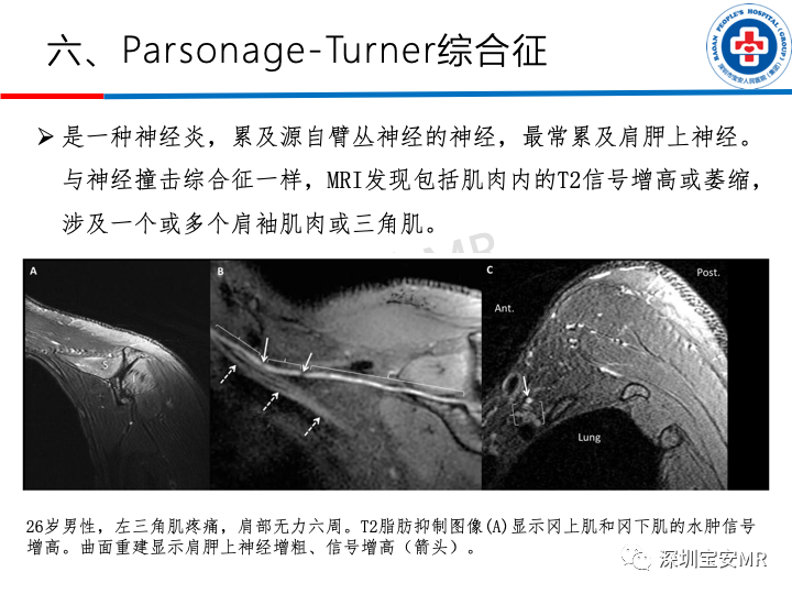 影像PPT - 【PPT】肩关节磁共振检查-13