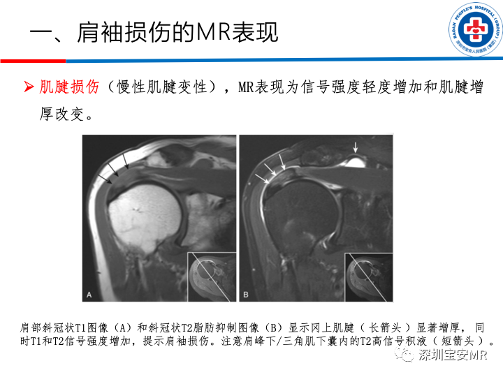 影像PPT - 【PPT】肩关节磁共振检查-7