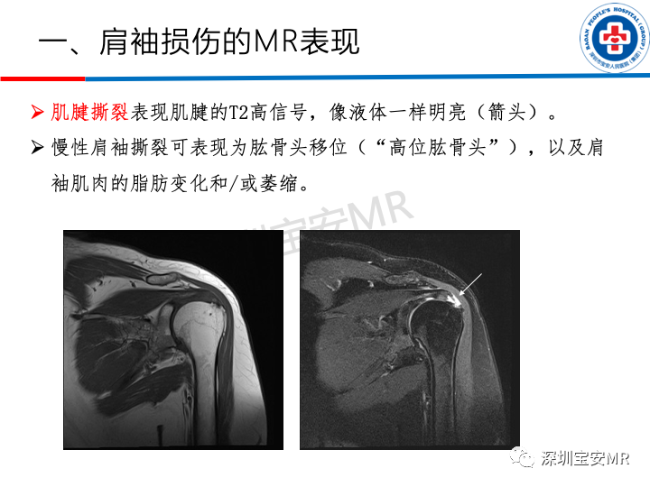 影像PPT - 【PPT】肩关节磁共振检查-1