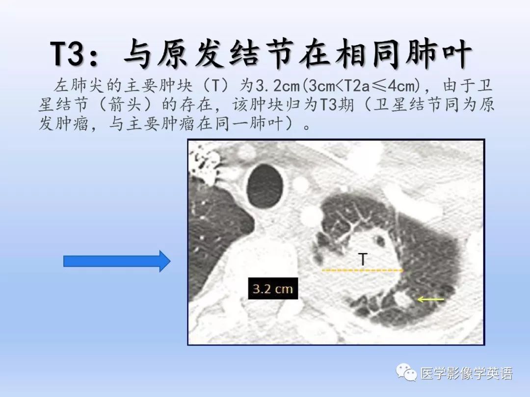 影像PPT - 【PPT】肺腺癌TNM分期影像学解读-13