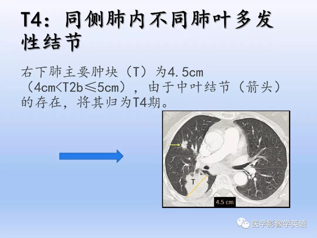 影像PPT - 【PPT】肺腺癌TNM分期影像学解读-14