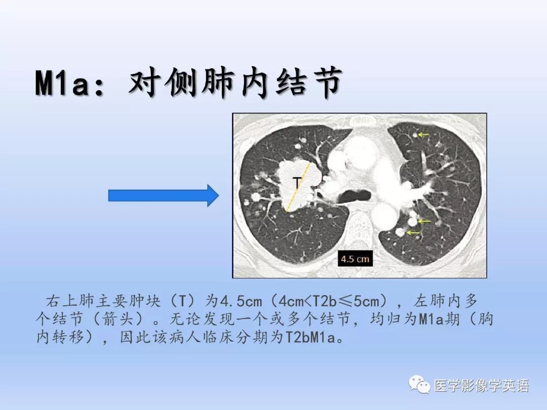 影像PPT - 【PPT】肺腺癌TNM分期影像学解读-16