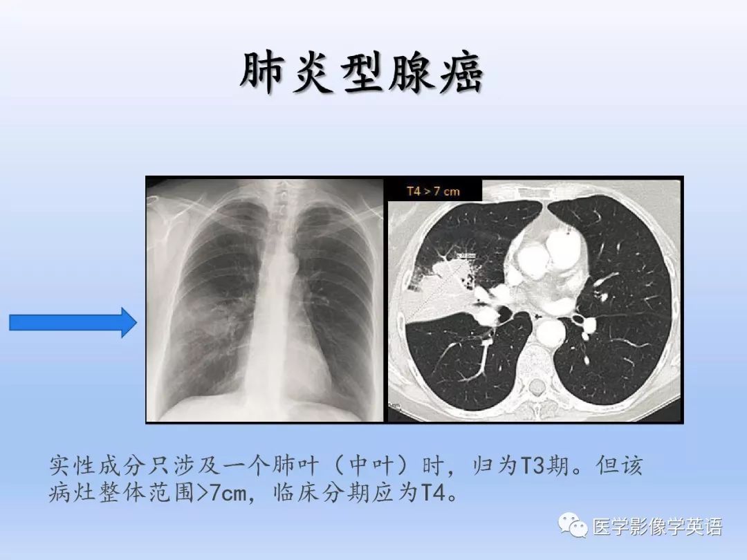 影像PPT - 【PPT】肺腺癌TNM分期影像学解读-21