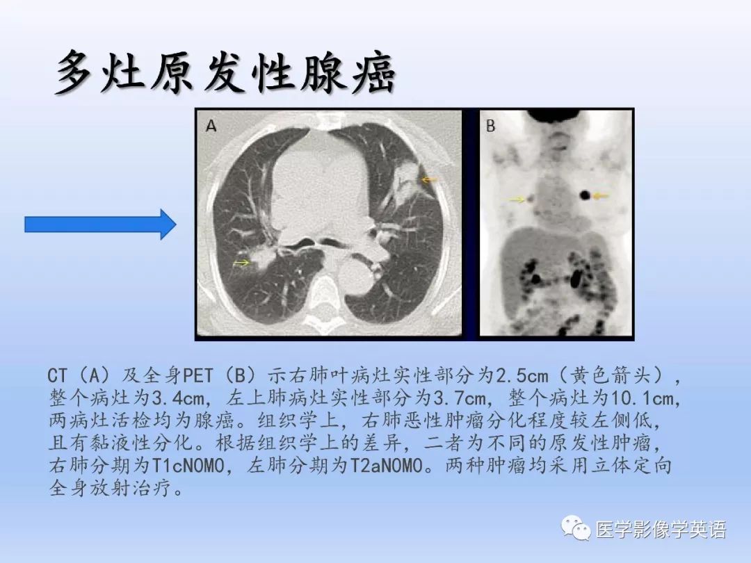 影像PPT - 【PPT】肺腺癌TNM分期影像学解读-25