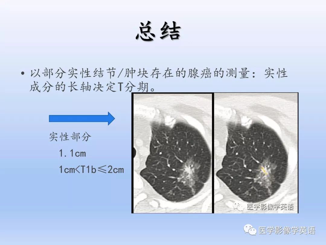 影像PPT - 【PPT】肺腺癌TNM分期影像学解读-30