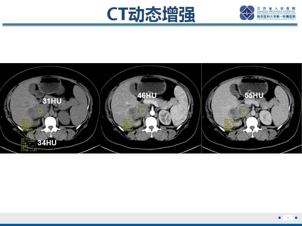 影像PPT - 【PPT】腹膜后平滑肌肉瘤-8