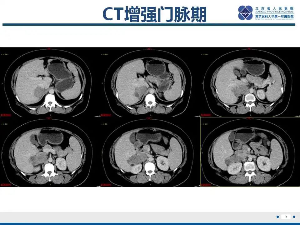 影像PPT - 【PPT】腹膜后平滑肌肉瘤-6