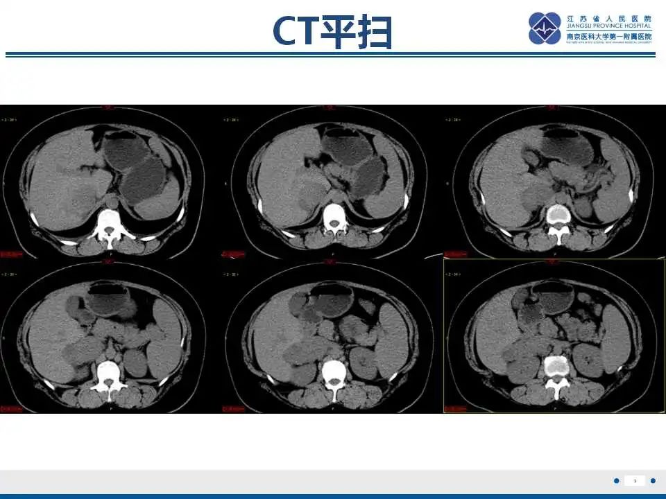 影像PPT - 【PPT】腹膜后平滑肌肉瘤-4