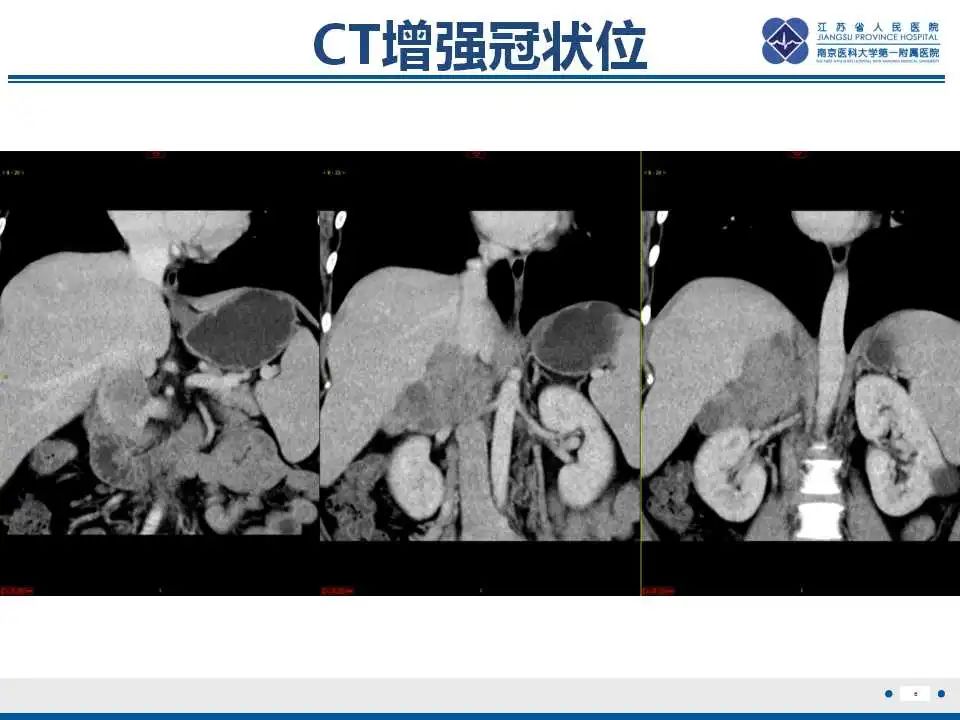 影像PPT - 【PPT】腹膜后平滑肌肉瘤-7