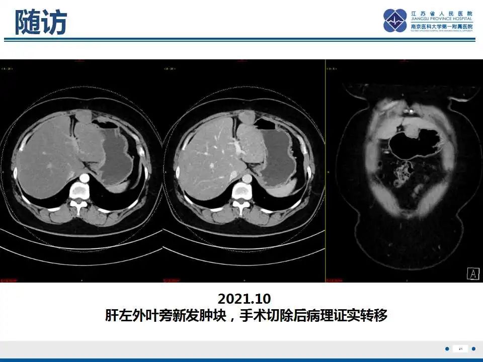 影像PPT - 【PPT】腹膜后平滑肌肉瘤-22