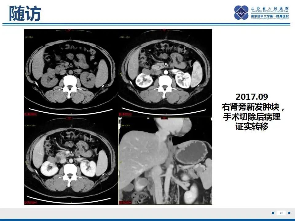 影像PPT - 【PPT】腹膜后平滑肌肉瘤-21