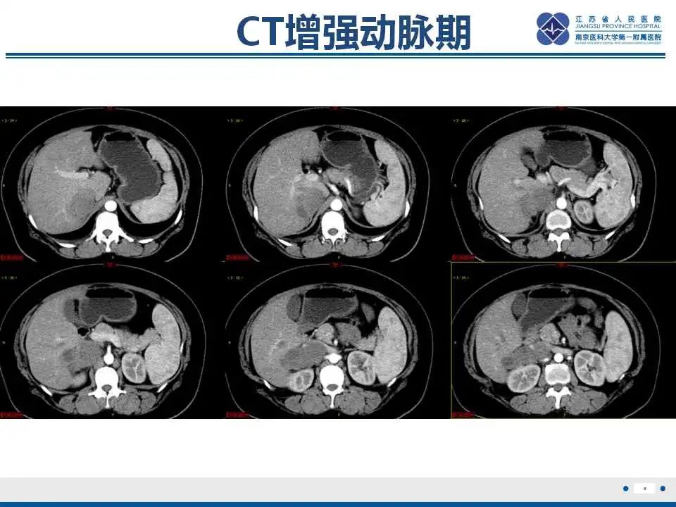 影像PPT - 【PPT】腹膜后平滑肌肉瘤-5
