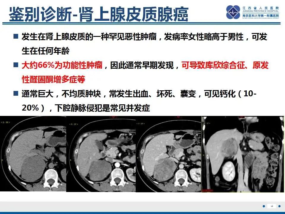 影像PPT - 【PPT】腹膜后平滑肌肉瘤-36