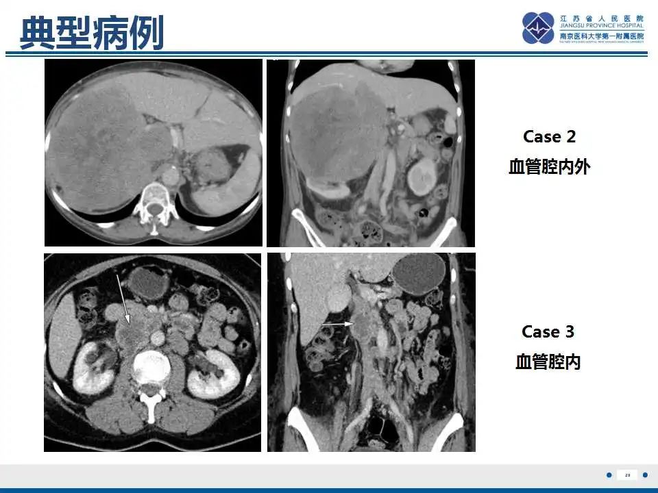 影像PPT - 【PPT】腹膜后平滑肌肉瘤-29