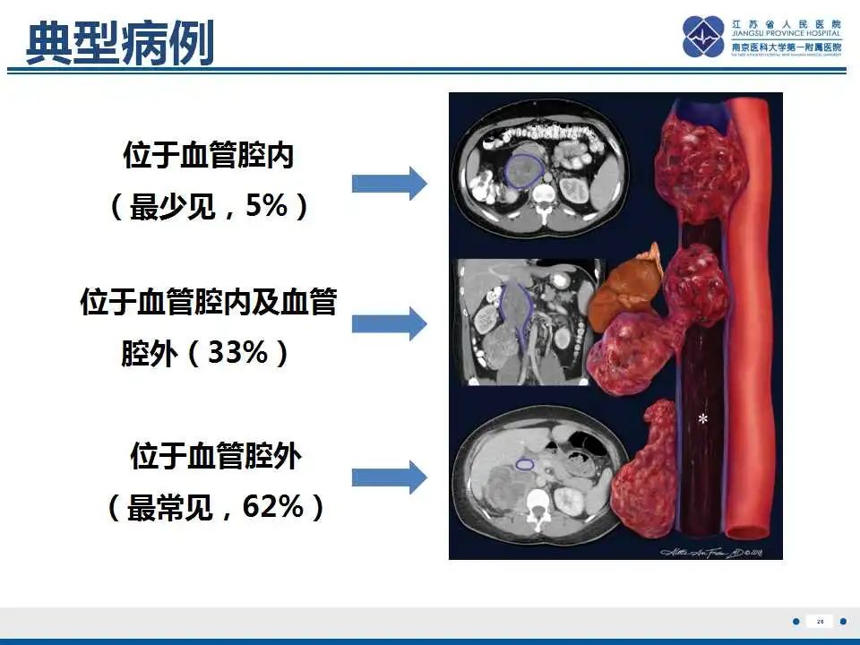 影像PPT - 【PPT】腹膜后平滑肌肉瘤-27